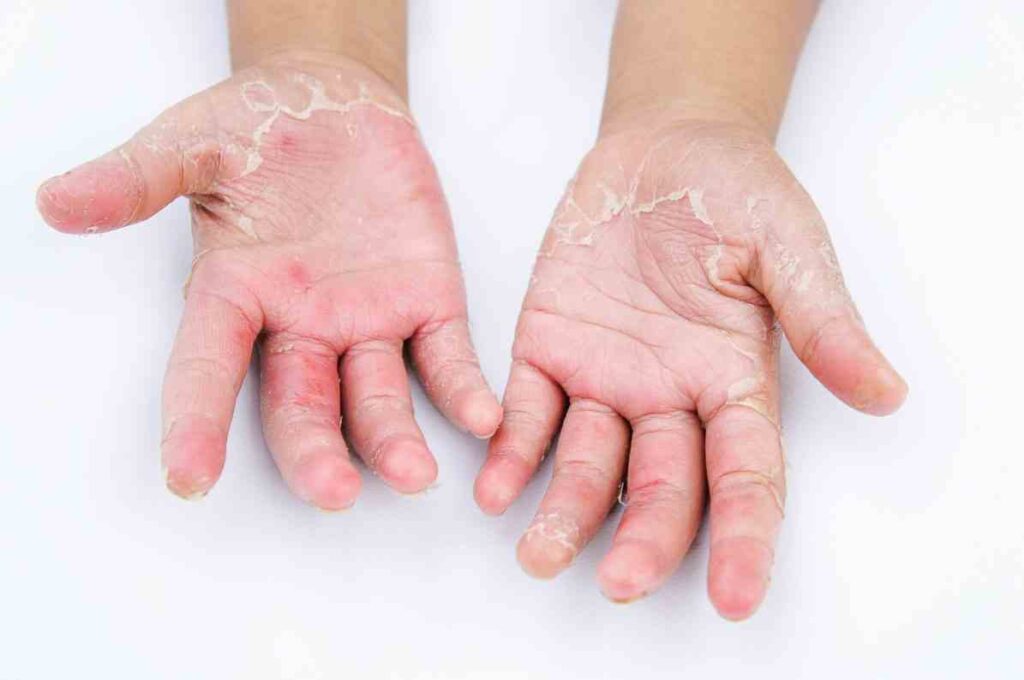 Loạt bệnh nguy hiểm do không đeo găng tay làm việc nhà, chế biến thực phẩm