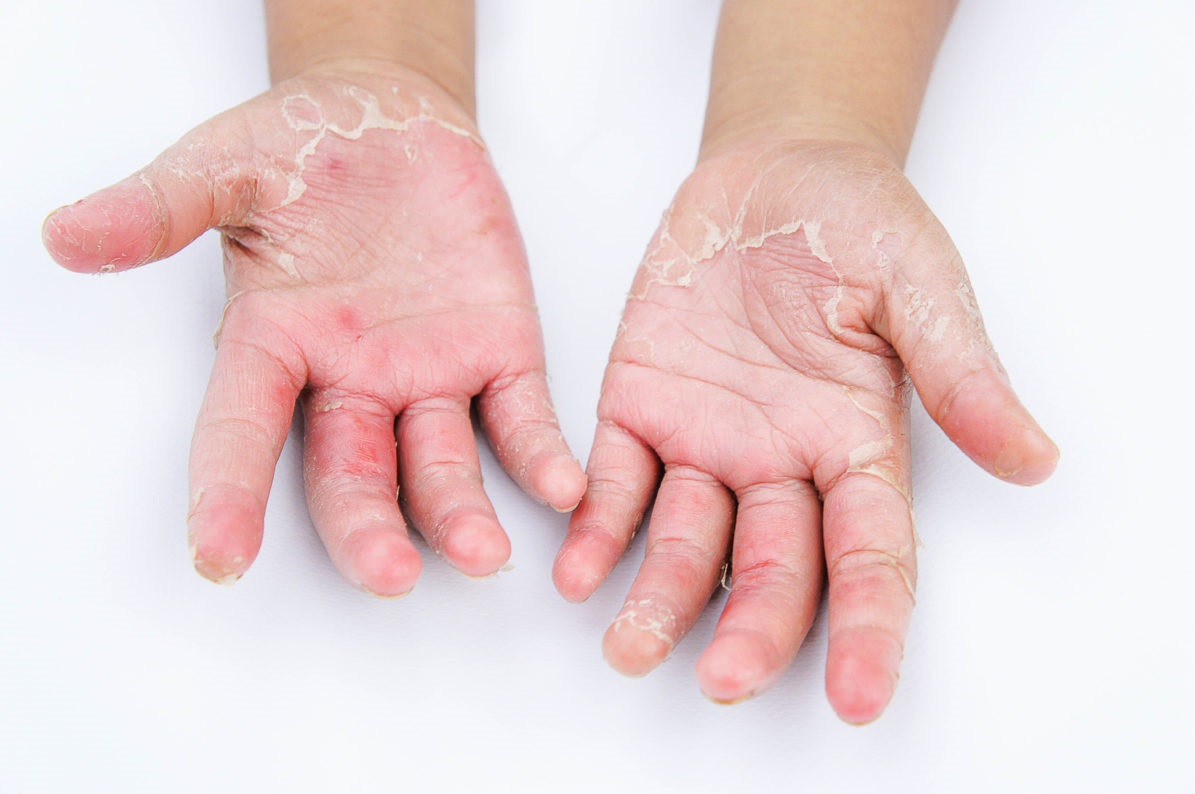 viêm da tiếp xúc kích ứng khi da tay tiếp xúc hóa chất thường xuyên