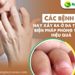 Các bệnh ngoài da ở da tay và biện pháp phòng tránh hiệu quả