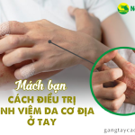 Mách bạn cách điều trị bệnh viêm da cơ địa ở tay