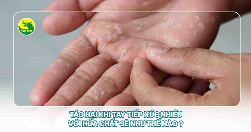 tay tiếp xúc nhiều với hóa chất