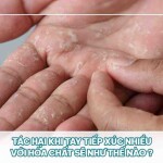 Tác hại khi tay tiếp xúc nhiều với hóa chất sẽ như thế nào?